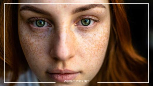 Rosacea